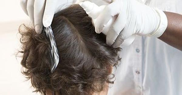 儿科医生提供控制儿童头虱的最新建议 儿科医生提供控制儿童头虱的最新建议