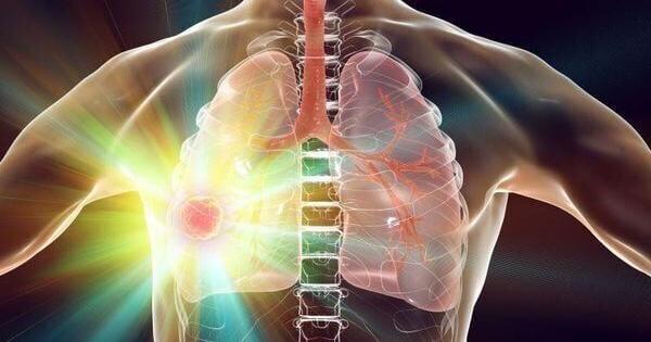 顶级医疗集团和医院敦促提供更好的肺癌筛查服务